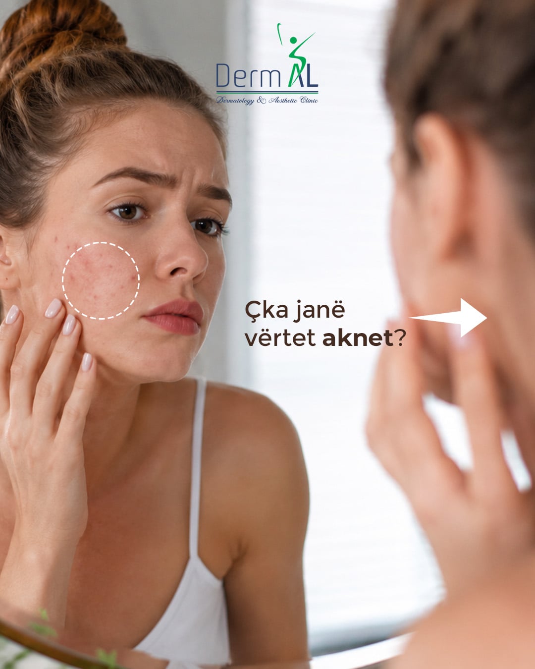 Informative post: “What are acne really?” with a girl in front of a mirror