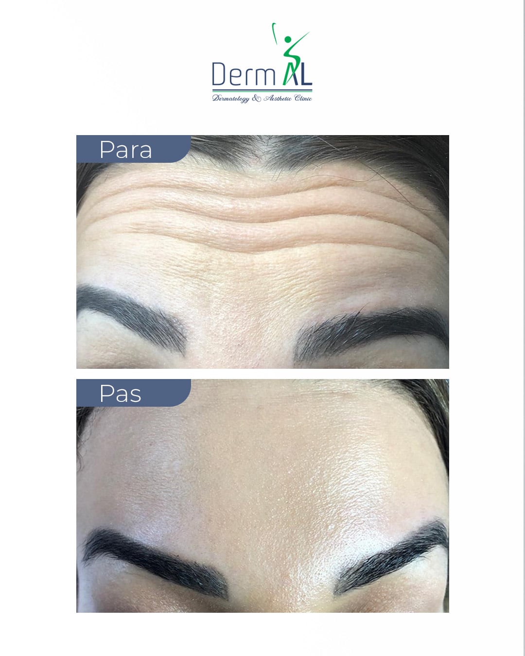Botox treatment post: forehead before and after treatment