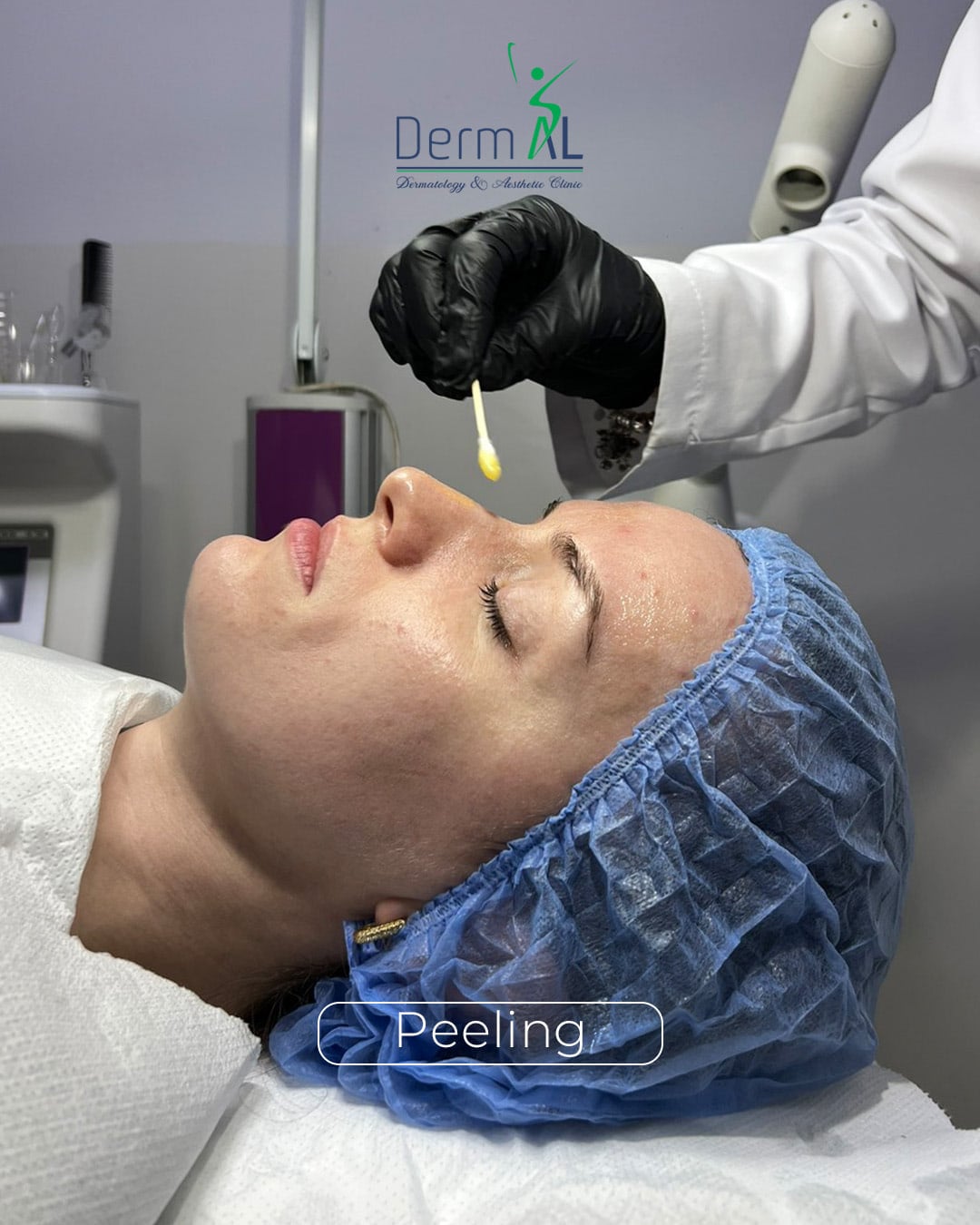 Photographic post: peeling treatment in the clinic