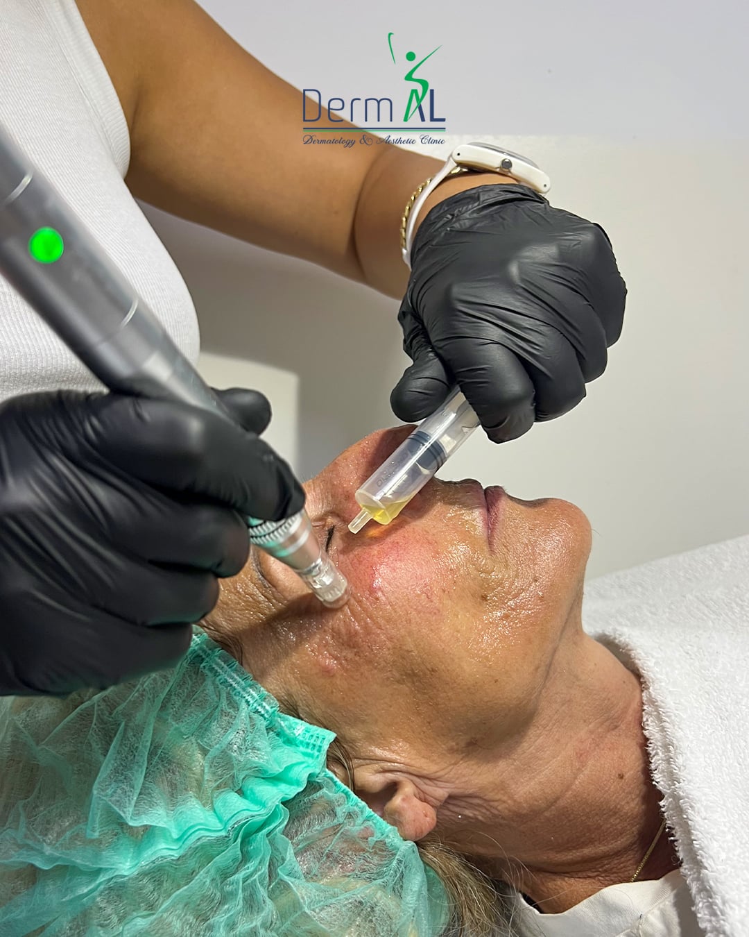 Photographic post: PRP facial treatment in the clinic